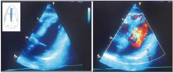 Echocardiographic image of the left ventricle three months after the event with no alterations in mobility and a preserved ejection fraction of 60%.