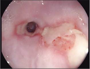Estenosis esof&aacute;gica, Esofagitis grado C y sospecha endosc&oacute;pica de metaplasia esof&aacute;gica.