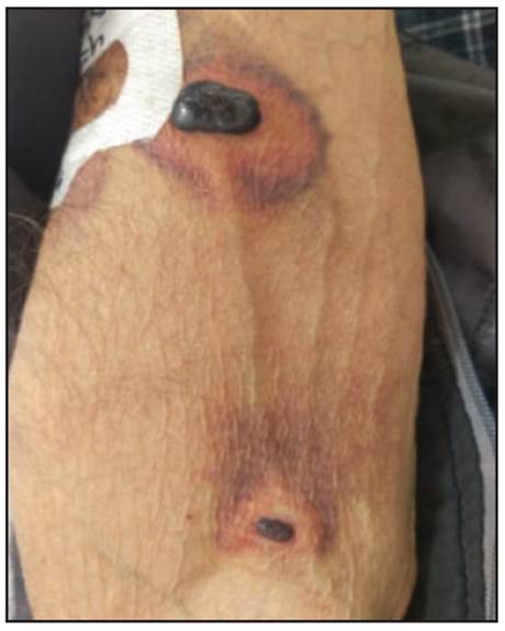 Lesions on the right arm.