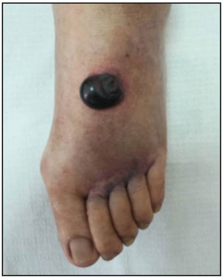 Lesions on the left foot.