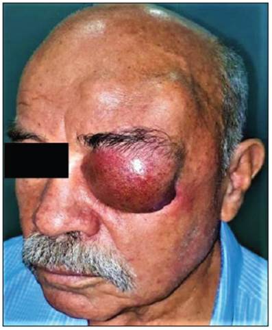 Left eye proptosis along with inflammatory changes and two satellite supraciliary adenopathies.
