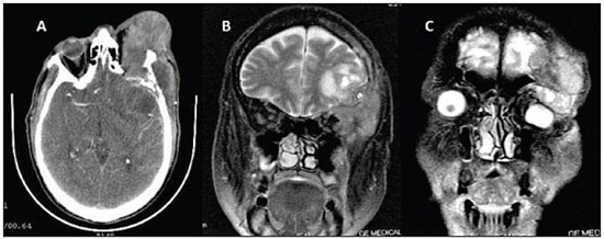 A. Simple head CAT showing clear invasion of the well-defined tumor mass towards the orbit, soft tissues and bone destruction in the left temporal region. B. T1 sequence nuclear magnetic resonance showing a heterogenous mass extending to the orbit and soft tissues in the temporal region. C. T2 sequence nuclear magnetic resonance from a coronal view showing a hyperintense, heterogenous lesion in the supratemporal orbit causing inferior displacement of the eyeball and frontal-zygomatic bone destruction.