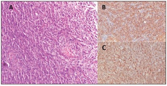 A. 200x microscopy (H&E) showing a fusicellular lesion with an infiltrative pattern made up of cells with elongated, oval, hyper chromatic, pleomorphic nuclei with visible nucleoli. Bizarre cells and more than 10 atypical mitoses in 10 fields can be seen. B-C. Immuno histochemistry showing positivity in the tumor population for desmin and AML.