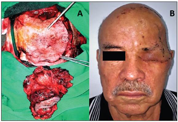 A. Block resection of the orbital tumor and reconstruction with a temporal island flap and a neurovascular flap. B. Post-surgical status of the patient with a large defect due to left lateral craniofacial resection.