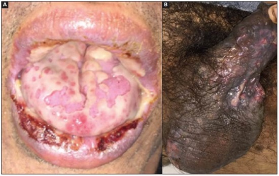 A. Severe stomatitis. Erosive cheilitis with serosanguinous scabs. The tongue has erosions covered by whitish membranes. B. Ulcerated lesions covered with a whitish membrane on the scrotum and foreskin