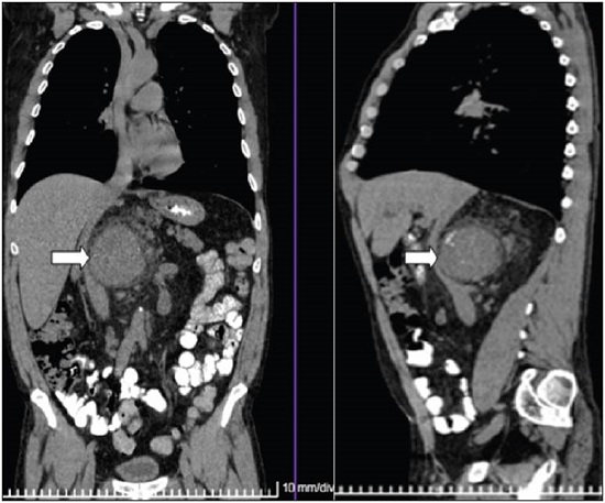 Abdominal CAT.A solid retroperitoneal mass with heterogenous density and multiple microcalcifications to the right of the midline due to Castleman disease in a patient with paraneoplastic pemphigus