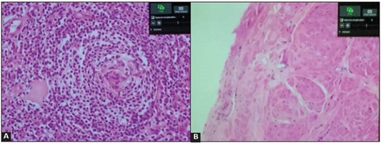 A. Histopathology of a retroperitoneal mass showing small lymphoid follicles with concentric arrangement of the lymphocytes, “onion skin” appearance of the angiofollicular hyperpla sia, compatible with hyaline vascular variant Castleman disease, (hematoxylin and eosin 40x). B. Histopathology of a skin lesion showing almost total loss of the epidermis with intraepidermal separation secondary to acantholysis and accompanying necrosis compatible with pemphigus (hematoxylin and eosin 40x).