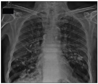 1. Chest x-ray showing a dense, bilateral micronodular pattern in the perihilar region.