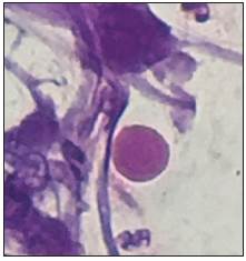 3. Hematoxylin and eosin staining of bronchoalveolar lavage liquid (100x) showing the presence of calcospherites