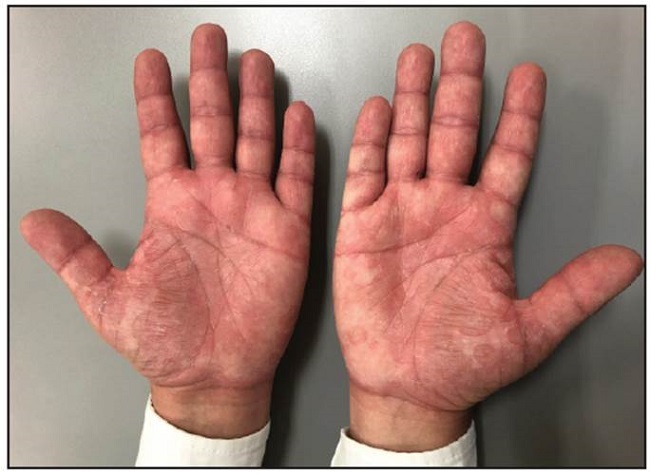 Maculopapular rash on the palms.