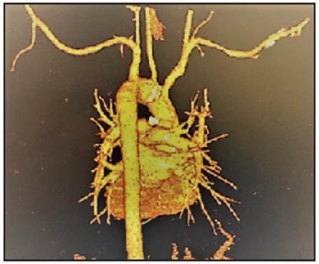 Aortic computed tomography angiography, with three dimensional reconstruction, showing a perforated penetrating ulcer in the aortic arch.