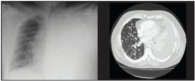 Chest x-ray and high-resolution tomography showing massive left pleural effusion which prevents the evaluation of the ipsilateral pulmonary parenchyma, and innumerable 5-23 mm pulmonary nodules in the right lung field.