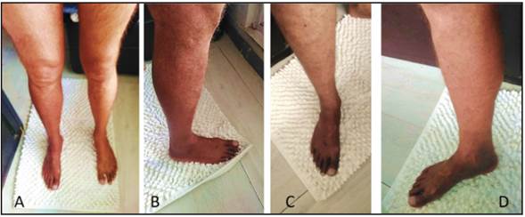 Sequential clinical images (A, B, C and D) of a 42-year-old male who had edema in the pelvic portion of the right lower extremity along with changes from a normal to a purplish color in the right ankle and foot over a span of 50 seconds.