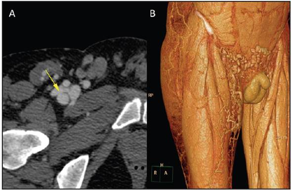 (A): an axial view of an iliofemoral computed tomography angiography of the connection between the anterior wall of the deep femoral artery and a blind venous sac connecting to the femoral vein. Note the mix of contrast in the venous territory in an arterial phase; (B): volumetric reconstruction of the iliofemoral computed tomography angiography in the venous phase, showing pre-pubic and right proximal thigh varicose bundles stemming from venous insufficiency driven by deep vein thrombosis.