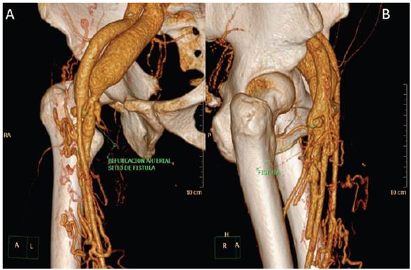 Volumetric reconstruction of the iliofemoral computed tomography angiography (A): frontal plane; (B): sagittal plane. The arrow indicates the ante rior wall of the proximal third of the deep femoral artery, as well as a blind venous sac draining to the femoral vein, with aneurysmal dilation of the iliac vein.