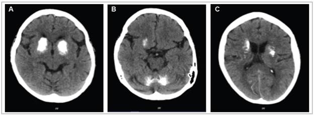 A simple axial head tomography showing marked intraparenchymal calcifications occupying almost all the basal ganglia, bilaterally, and the central region of the cerebellar lobes.