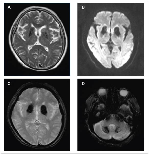 Magnetic resonance imaging of the brain in the T2 (A), Diffusion (B), and T2 GRE (C,D) sequences of the axial plane. Hypointensity is seen bilaterally in the head of the caudate and putamen due to ferromagnetic material deposits (A), hyperintensity in the same locations (B), symmetrical hyperintensity in the basal ganglia (C), and hyperintensity in the dentate nuclei of the cerebellum (D).