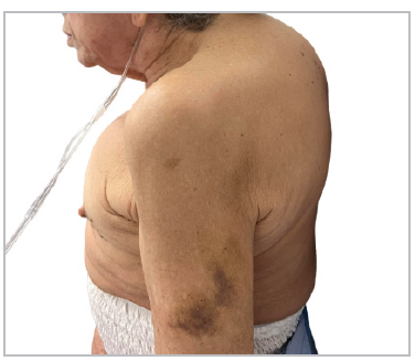Pectus excavatum with anterior protrusion of the distal segment.