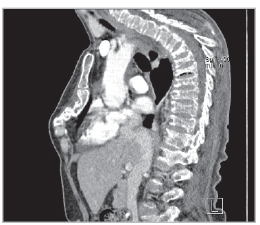 Sagittal bone window image from a chest tomography.