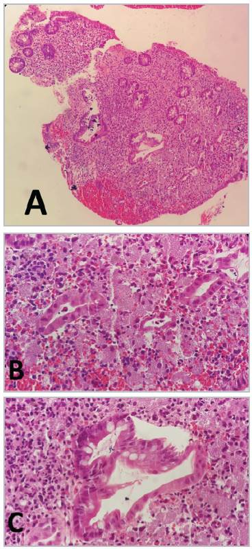 Histopathology A. 10x B. 40X C. 100X. Colon mucosa with widespread ulceration, covered by fibrinous material and neutrophils arranged in microabscesses; the crypt epithelium has reactive changes, the lamina propria is enlarged with mixed inflammatory infiltrate and numerous histiocytes with abundant cytoplasm and eosinophils with uncountable yeast-like structures characteristic of ulcerative colitis associated with histoplasmosis.