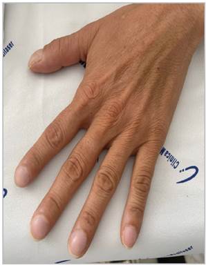 Signs of nail clubbing.