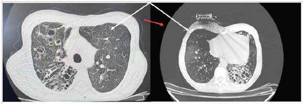 A high-resolution CAT without contrast. Axial plane. Different-sized cystic images. The cysts tend to be round or oval but may be polygonal (red arrow) when there is severe paren chymal involvement. Septal thickening, fibrous scar tracts, bronchiectasis, nodules and ground glass (white arrow) can be seen.