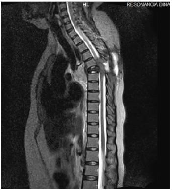 Magnetic resonance imaging of the thoracic spine in a T2 sagittal sequence showing a blastic bone lesion at T5 which affects the vertebral body, pedicle and transverse process.