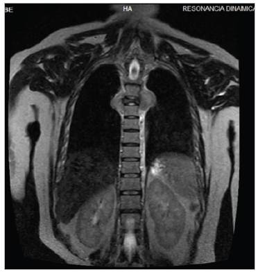 Magnetic resonance imaging of the thoracic spine in a T2 coronal sequence showing
a blastic bone lesion at T5 affecting the vertebral body, pedicle, transverse process and right
costovertebral joint, leading to a reduced intervertebral diameter..