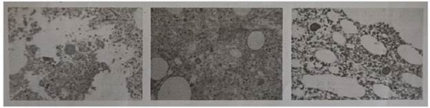 A vertebral biopsy showing chronic osteomyelitis associated with endosporulated spherules, compatible with coccidioides.
