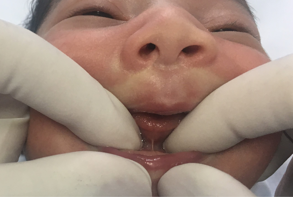 Clinical aspect of the lingual frenulum by means of digital evidence maneuver and anesthesia