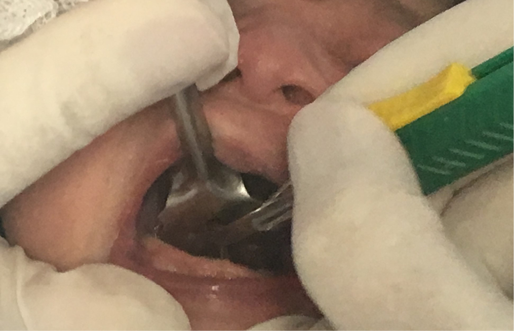 Section of the lingual frenulum with knife scalpel 15 using tentacanula