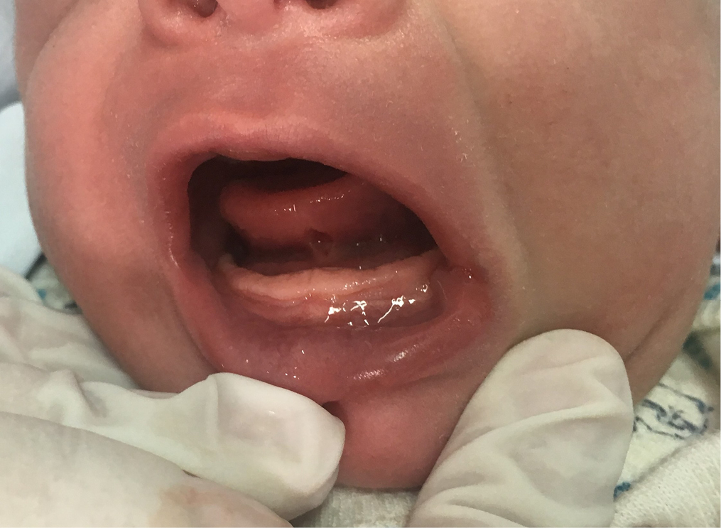 Postoperative clinical appearance after 5 minutes of breastfeeding