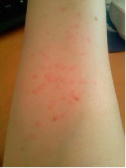 Urticaria acuagnica en el antebrazo de la paciente caso