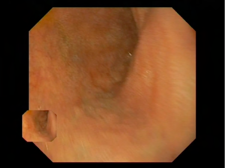 Gastroscopia que muestra atrofia de la mucosa duodenal
