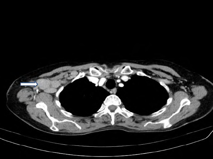 TAC torcico mostrando mltiples adenopatas axilares derechas
