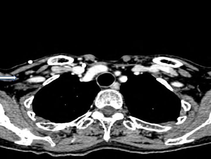 TAC torcico 3 aos despus sin evidencia de adenopatas