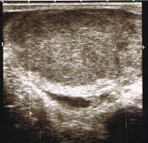 Ecografa testicular. Se aprecia una alteracin de la ecoestructura de forma difusa sin presencia de quistes ni calcificaciones