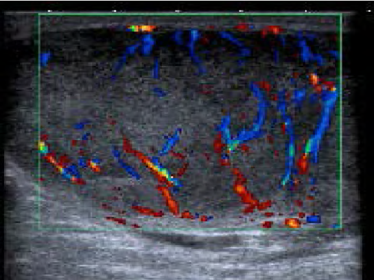 Ecografa testicular. Se observa un testculo aumentado de tamao con alteracin difusa de la ecogenicidad, sin calcificaciones, presenta aumento difuso de la vascularizacin