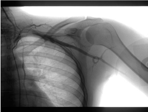Angio-TAC donde se visualiza aneurisma subclavio izquierdo