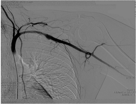 Arteriografía donde se confirma dilatación aneurismática subclavia izquierda