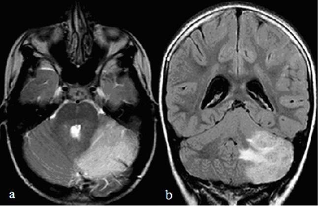 a (TRA T2) y b (COR Flair). Edema con engrasamiento e hiperse&ntilde;al cortical en hemisferio cerebeloso izquierdo que marca las folias. Afectaci&oacute;n de la sustancia blanca con efecto masa y leve ventriculomegalia.