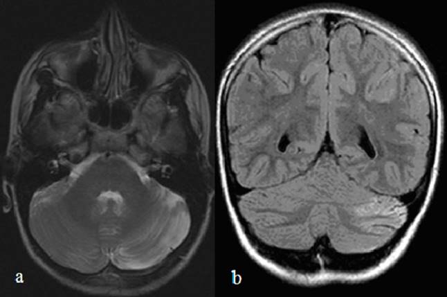 a (TRA T2) y b (COR Flair). Persiste leve hiperintensidad cortical en T2 y Flair con disminuci&oacute;n de la ventriculomegalia.