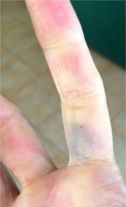 Cambios de coloración en la falange proximal del segundo dedo de la mano derecha tras la administración accidental de adrenalina.