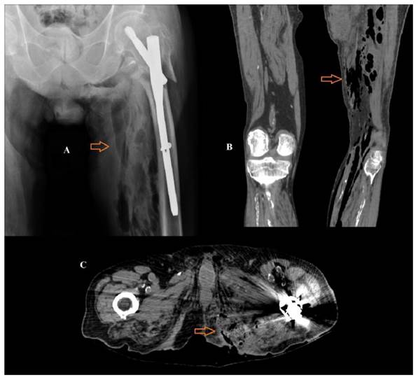 A. Radiograf&iacute;a de cadera donde se observa aire en el interior del muslo y en la vecindad de la tuberosidad isqui&aacute;tica izquierda. B. Reconstrucci&oacute;n coronal de TC que muestra c&oacute;mo el aire afecta y diseca los planos musculares del muslo y la pierna. C. Corte axial de TC donde se aprecia una irregularidad cut&aacute;nea con presencia de burbujas a&eacute;reas que se extienden hacia la regi&oacute;n perineal izquierda profunda, correspondiente a una &uacute;lcera por presi&oacute;n.