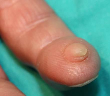 Lesi&oacute;n polipoide, indurada y no m&oacute;vil, con un tama&ntilde;o de 1,1 cm x 0,9 cm aproximadamente en el pulpejo del 5&ordm; dedo de la mano derecha.