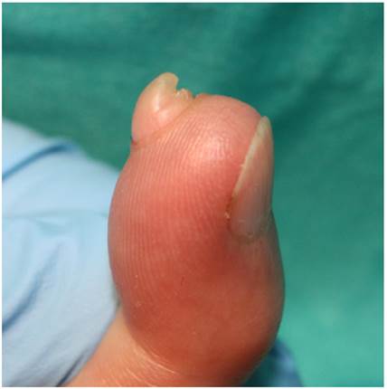 Vista lateral de la lesi&oacute;n.