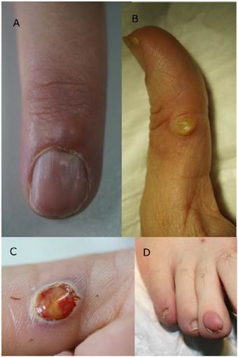 Diagn&oacute;stico diferencial de tumores digitales. A. Quiste mixoide digital. B. Verruga vulgar. C. Granuloma pi&oacute;geno. D. Tumor de K&ouml;enen.