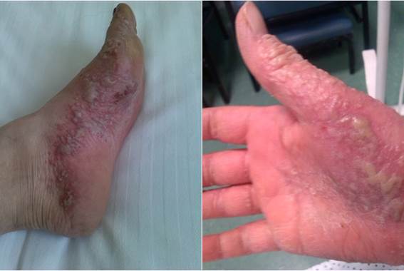 Lesiones antes del tratamiento.