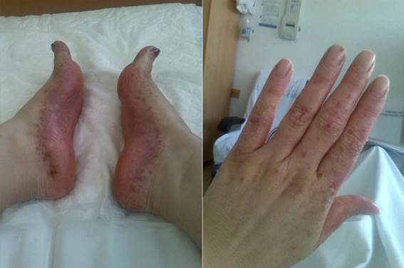 Lesiones después del tratamiento.