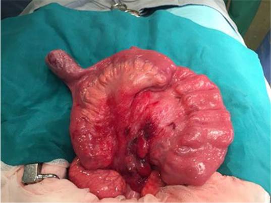 Localización del divertículo de Meckel.